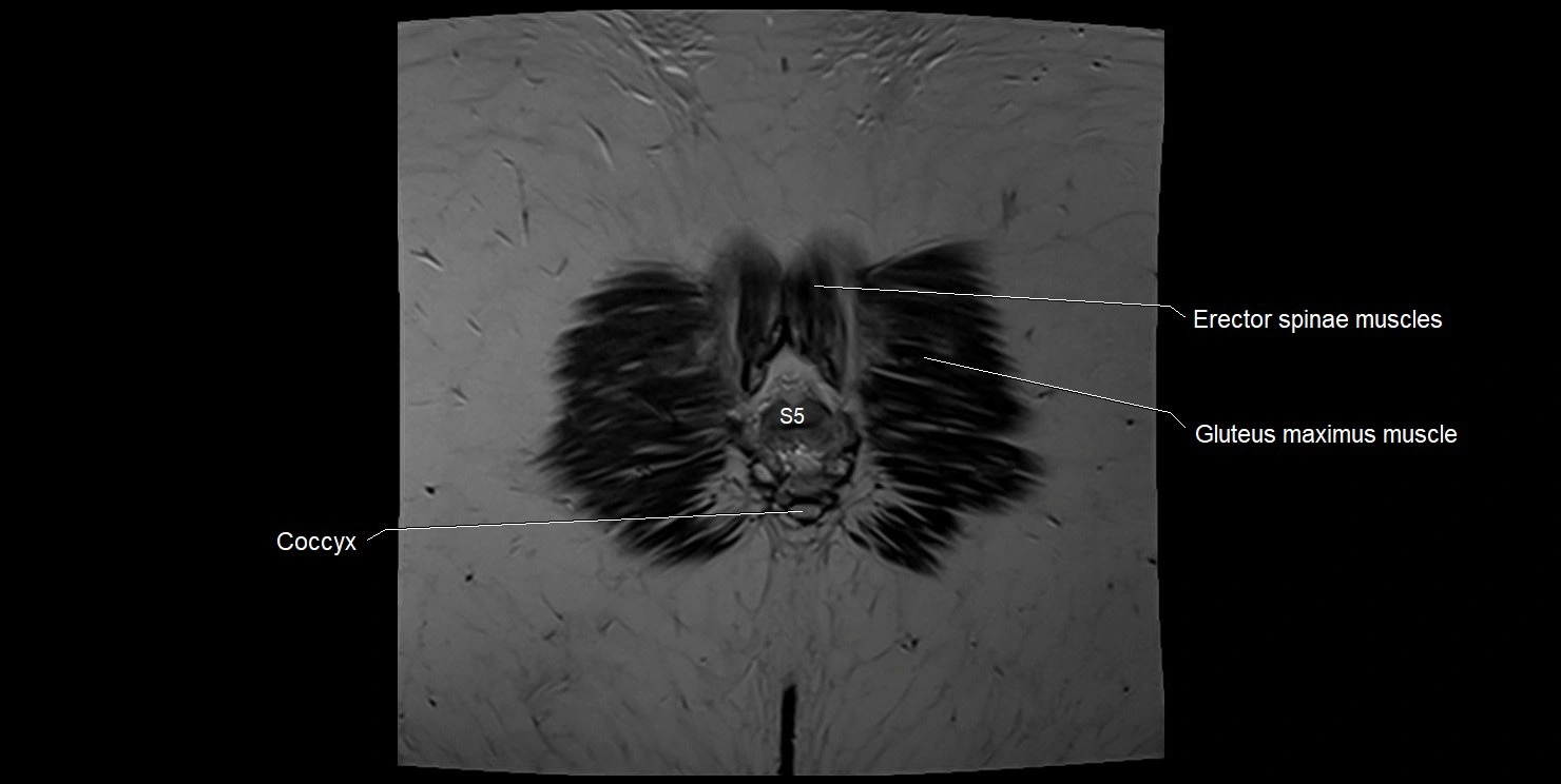 female pelvis coronal cross sectional anatomy image 37.webp